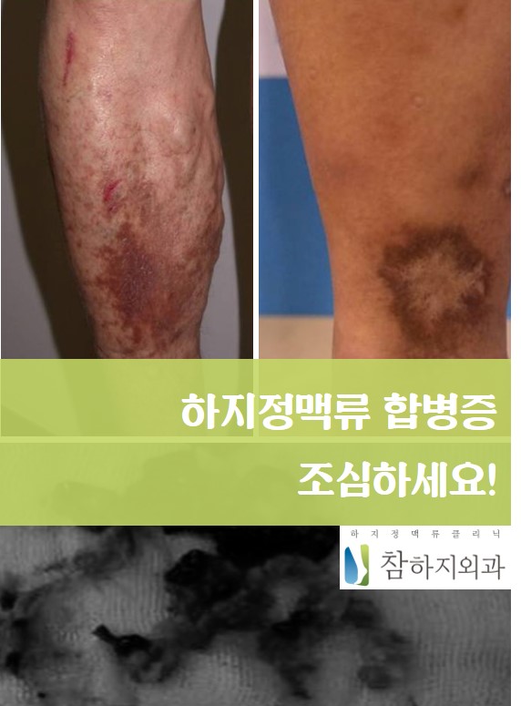 하지정맥류 합병증.jpg