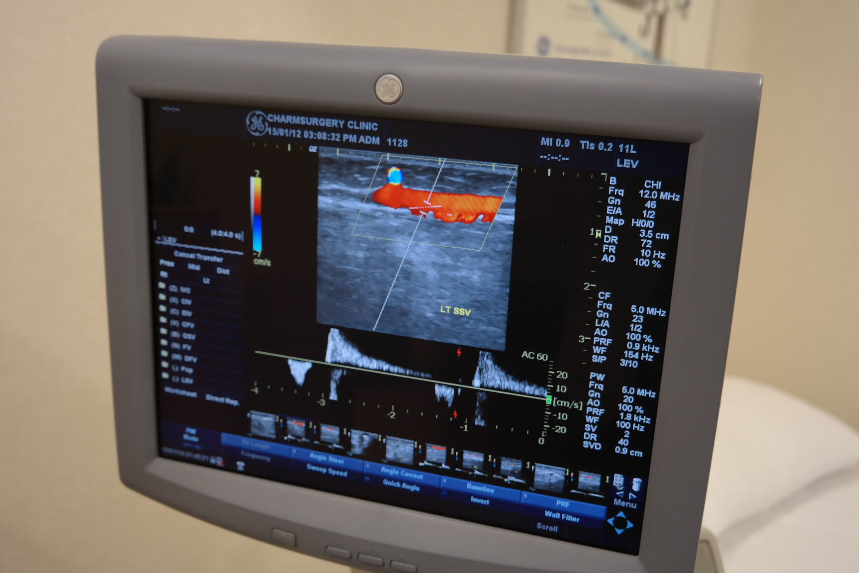 하지정맥류 역류.JPG