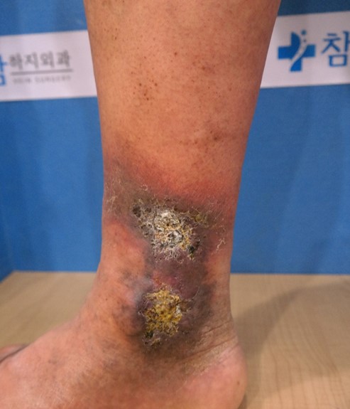 하지정맥류궤양.jpg