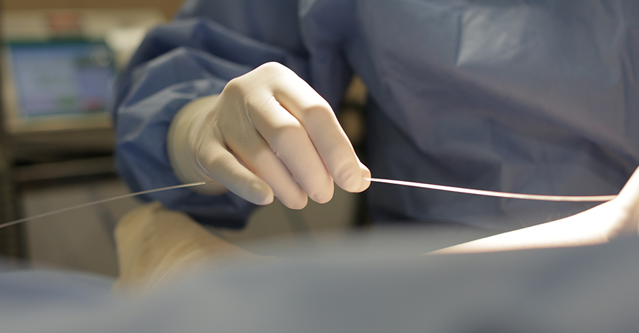 발거술 하지정맥류의 치료