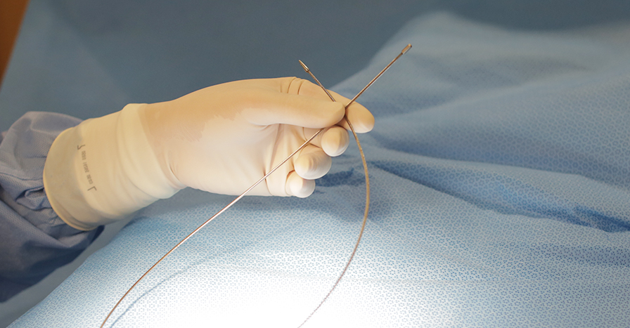 발거술 하지정맥류의 치료