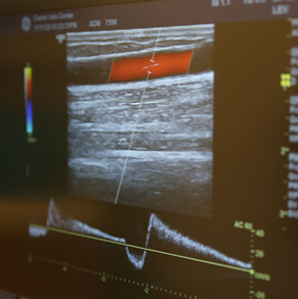 발거술 하지정맥류의 치료