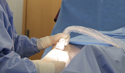 발거술 하지정맥류의 치료