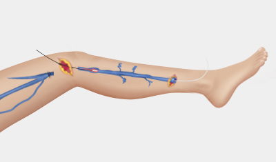발거술 하지정맥류의 치료