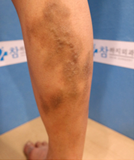 고주파수술 하지정맥류의 치료