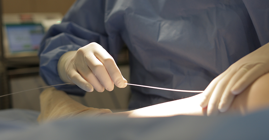 베나실 하지정맥류의 치료