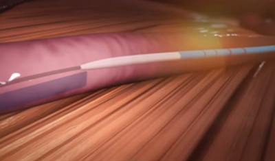 베나실 하지정맥류의 치료