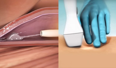 베나실 하지정맥류의 치료