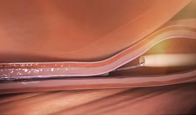 베나실 하지정맥류의 치료