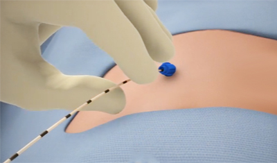 클라리베인 · 플레보그립 하지정맥류의 치료