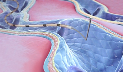 클라리베인 · 플레보그립 하지정맥류의 치료