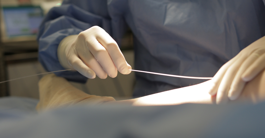 혈관경화요법 하지정맥류의 치료