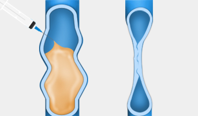 혈관경화요법 하지정맥류의 치료