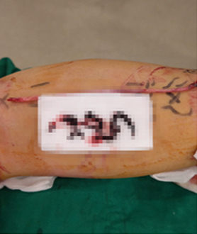 정맥류제거술 하지정맥류의 치료