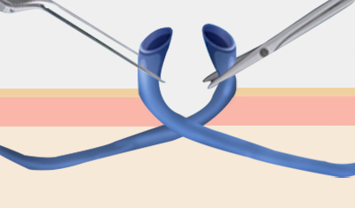 정맥류제거술 하지정맥류의 치료