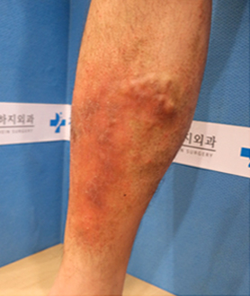 보존적치료 하지정맥류의 치료