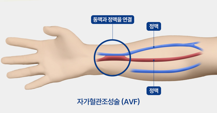 투석혈관 관리와 치료하기 투석혈관