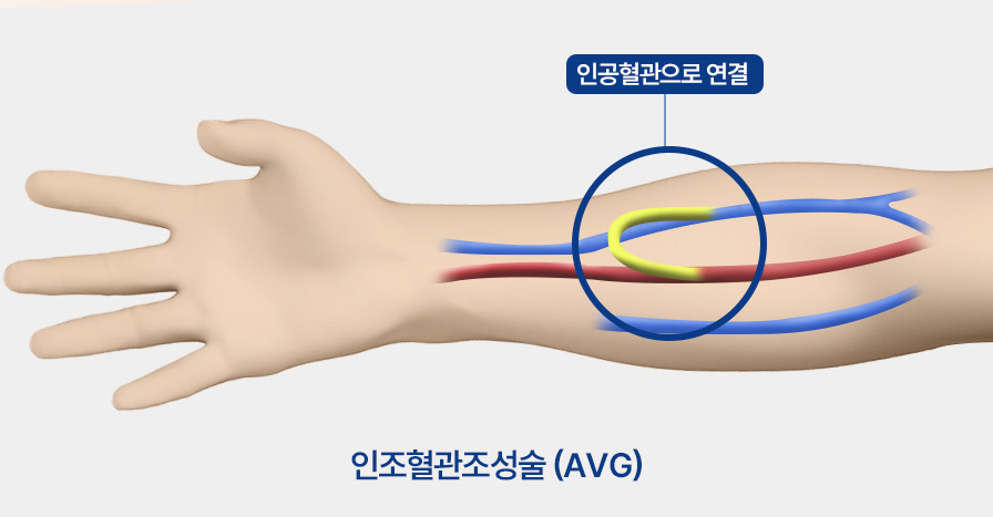 투석혈관 관리와 치료하기 투석혈관