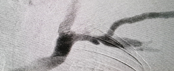 투석혈관 관리와 치료하기 투석혈관