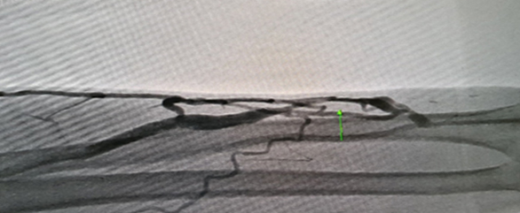 투석혈관 관리와 치료하기 투석혈관