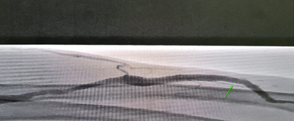 투석혈관 관리와 치료하기 투석혈관