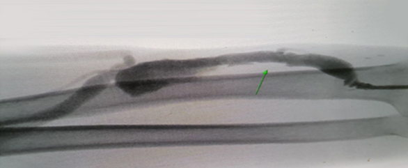 투석혈관 관리와 치료하기 투석혈관