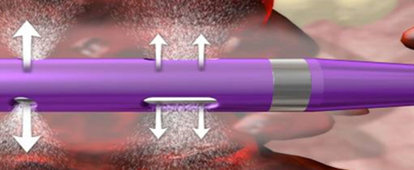엔지오젯 투석혈관