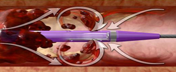 엔지오젯 투석혈관