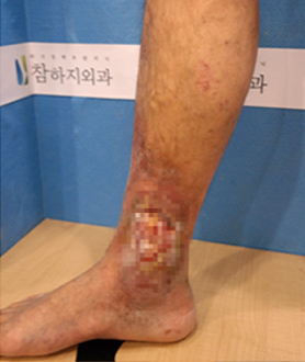 하지정맥류의 증상 하지정맥류