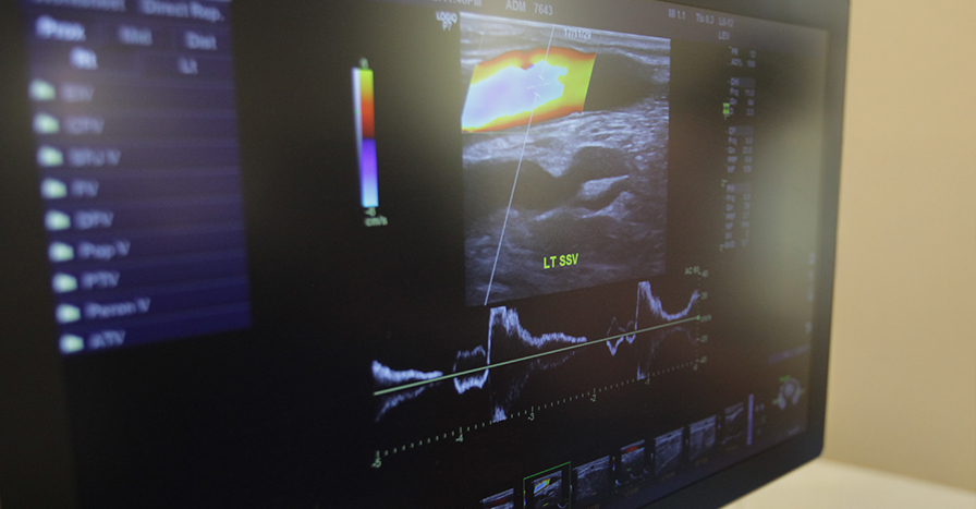 하지정맥류의 증상 하지정맥류