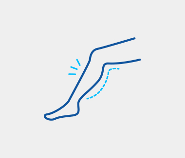 하지정맥류의 증상 하지정맥류