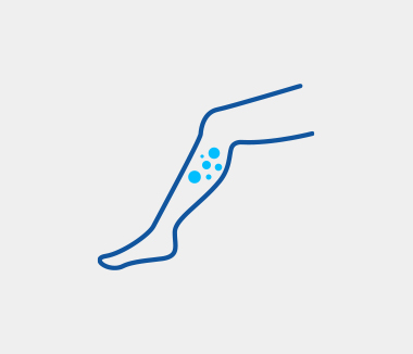 하지정맥류의 증상 하지정맥류