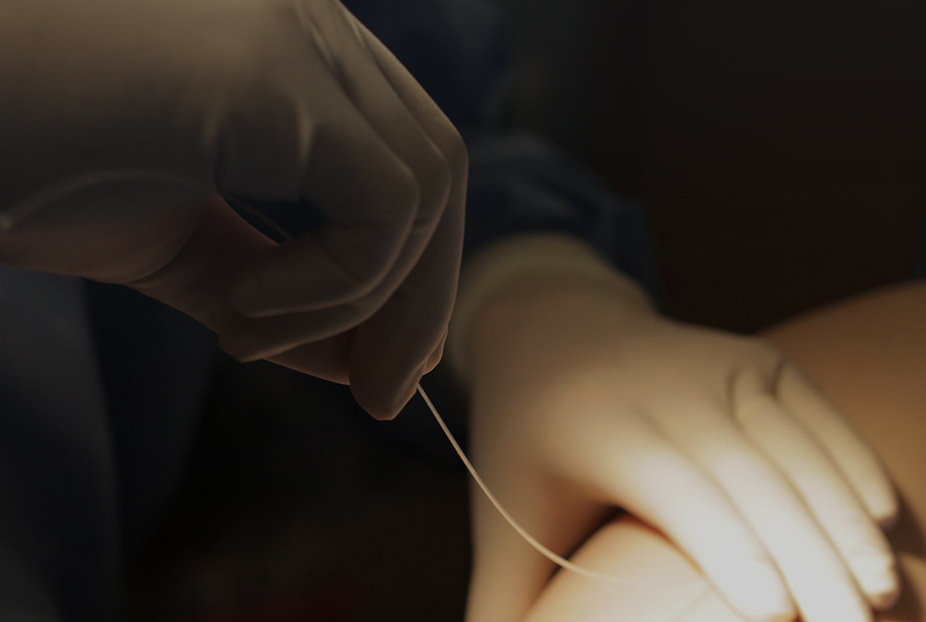 하지정맥류의 예방법 하지정맥류